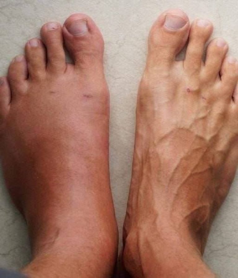 Hier sind die 6 Symptome